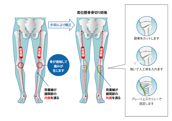 主な膝・スポーツ疾患の治療について | 治療について | 松戸整形外科病院